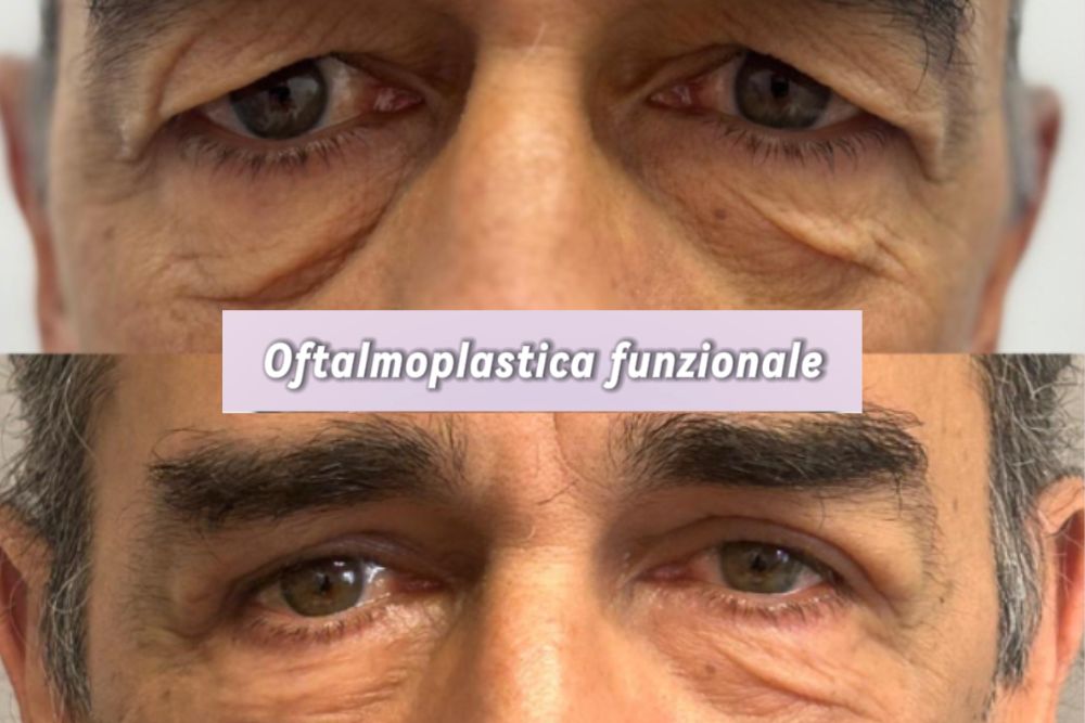 Campo visivo palpebre pesanti