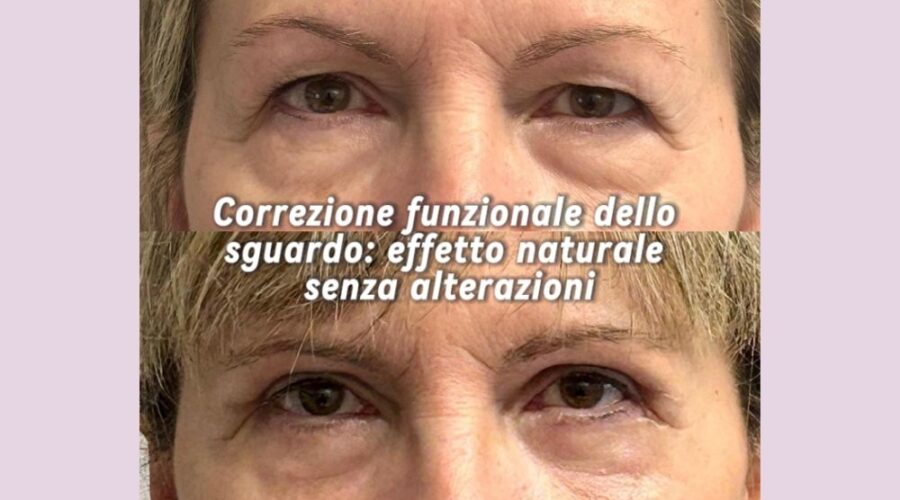 blefaroplastica combinata caso clinico