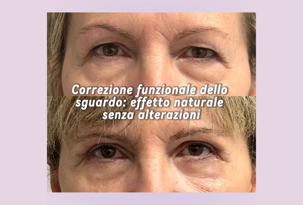 blefaroplastica combinata caso clinico