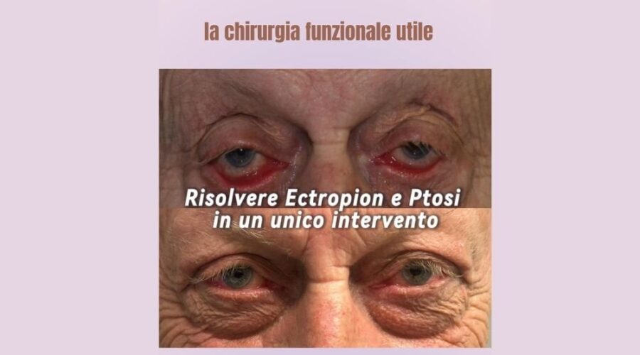 intervento combinato palpebre