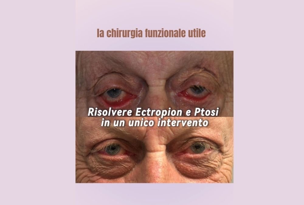 intervento combinato palpebre