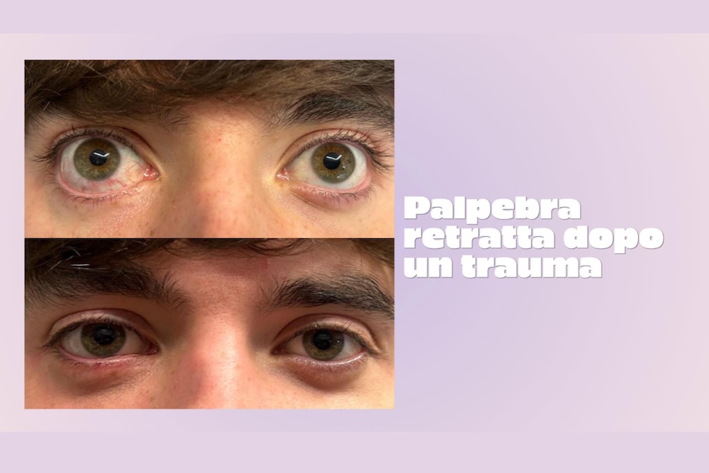 Retrazione palpebrale dopo frattura dell'orbita: occhi prima (in alto) e dopo l'intervento (in basso)