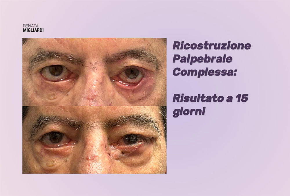 Ricostruzione palpebrale complessa con innesto di palato duro: occhi prima e 15 giorni dopo l'intervento